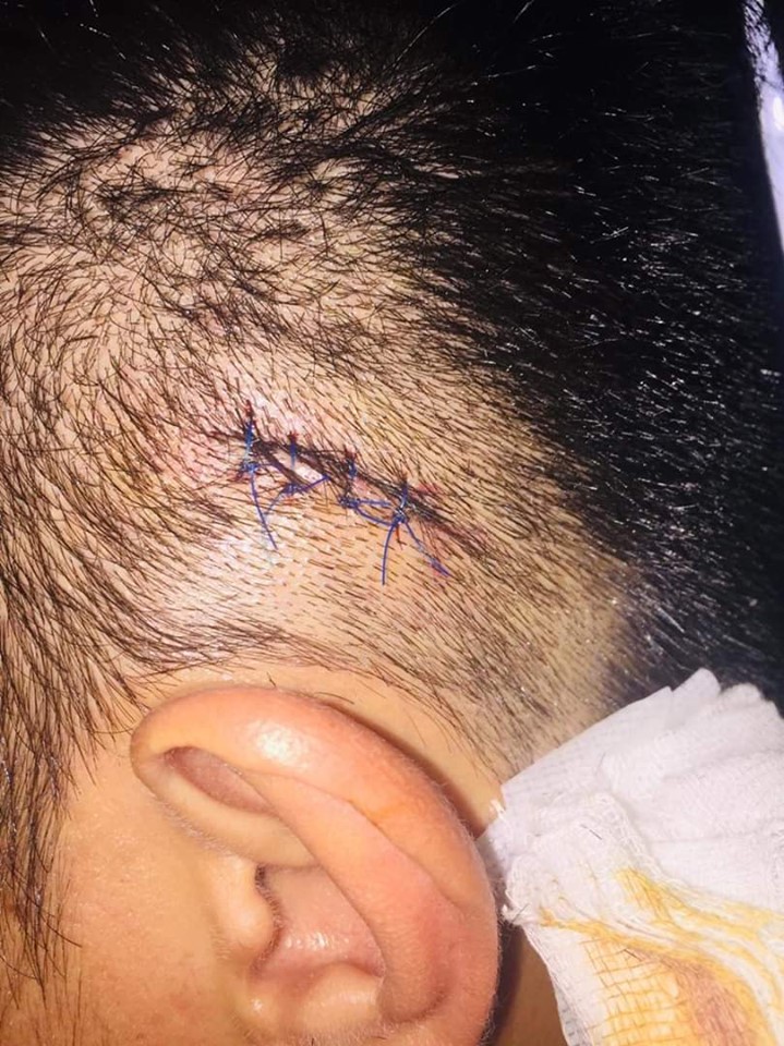 Zimmerman's wound from an Empi Light. | Photo by Josephine Bayot
