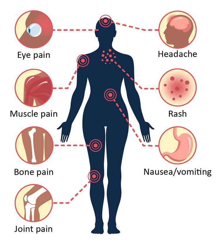 the dengue saga: mythbusters v2 | platelets : how low art thee, let me count how (or should i?) 1 Symptoms of dengue. Image source: Centers for Disease Control and Prevention